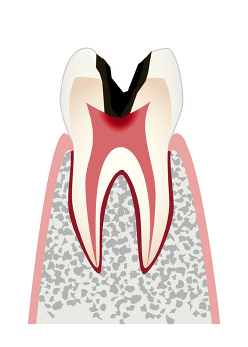 歯髄に達した虫歯